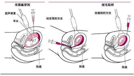 羊膜穿刺