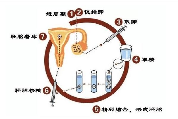 输卵管结扎后如何进行试管婴儿？