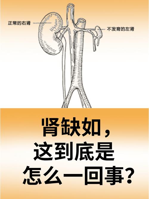 肾缺如