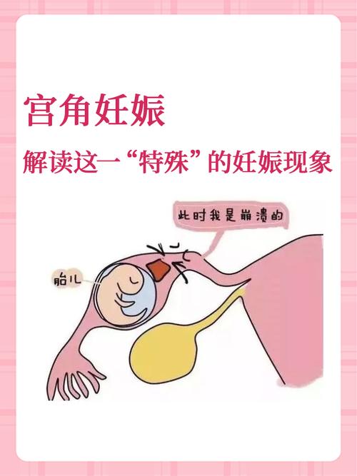 宫角妊娠