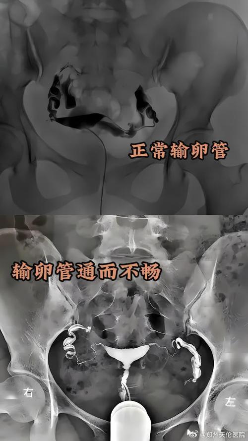 输卵管阻断