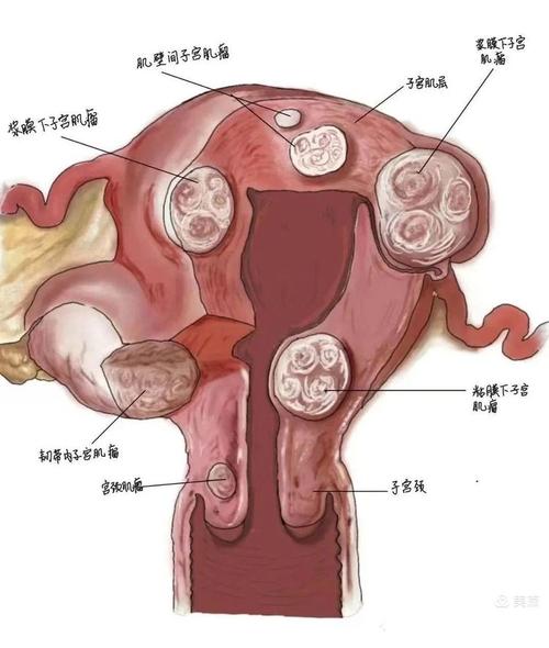 宫颈子宫肌瘤