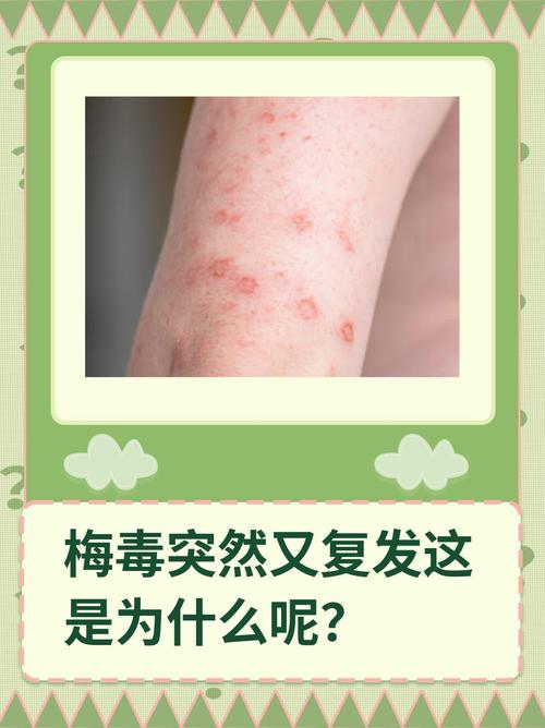 梅毒复发