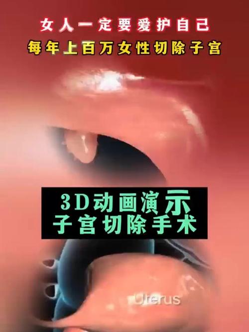 切除子宫