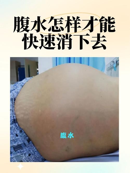 腹水痒