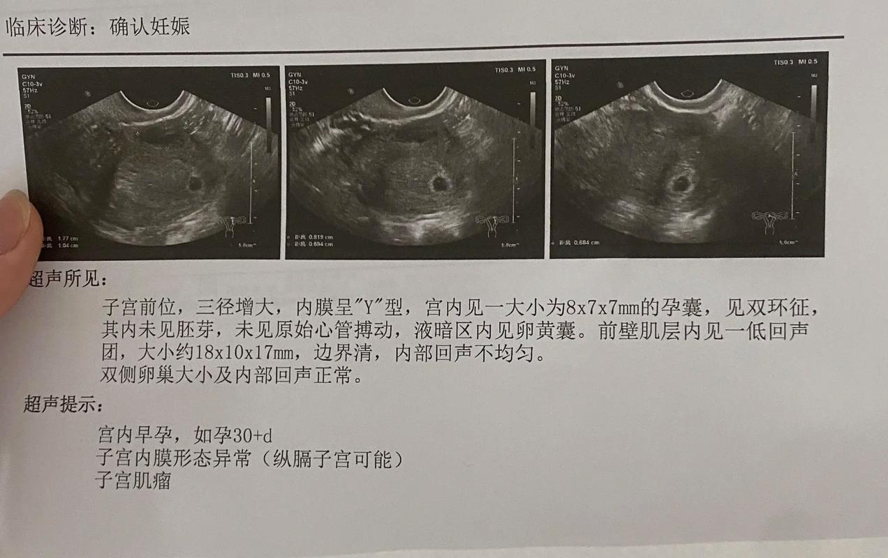 宫内早期妊娠