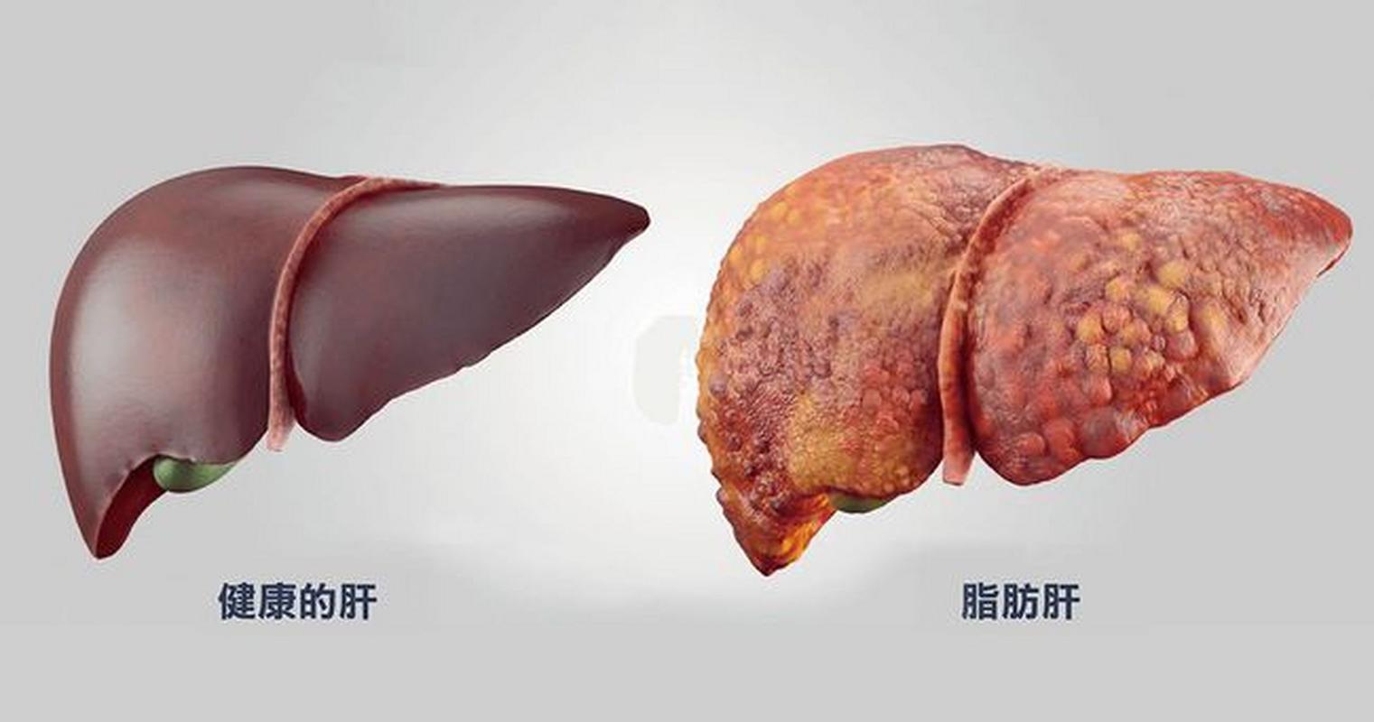 脂肪肝