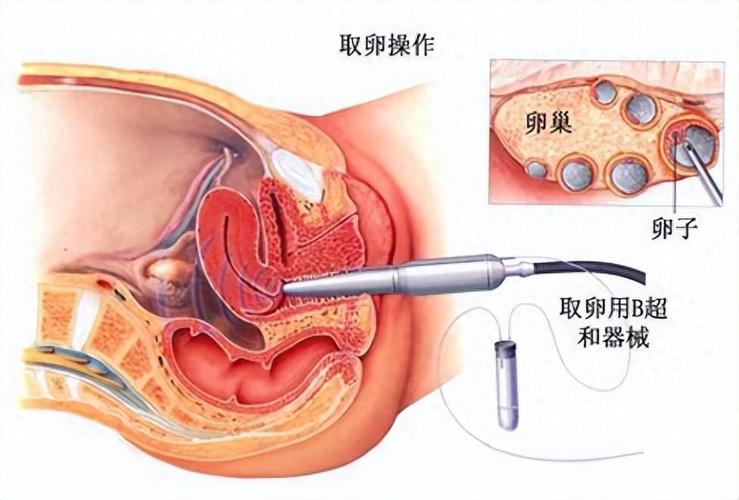 未婚女性如何进行试管婴儿手术？