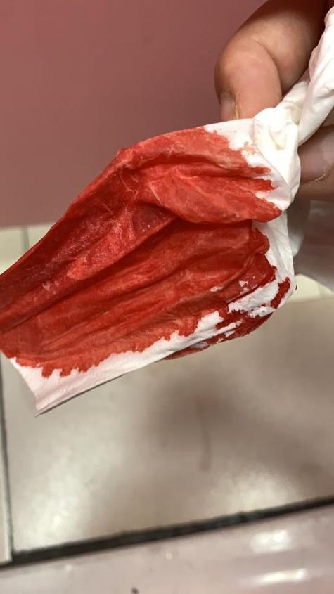 试管婴儿怀上后为何会流血？