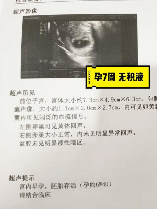 孕囊积液