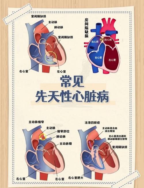  先心病预防