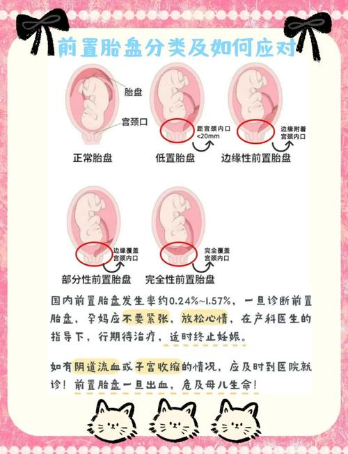 胎盘低位