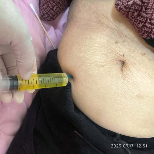 腹水抽取