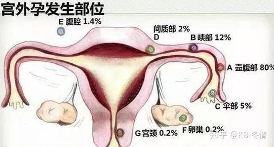 试管婴儿真的容易发生宫外孕吗？