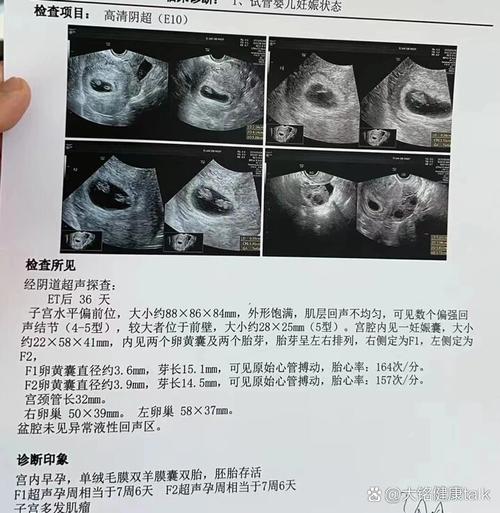 试管婴儿双胎儿子成功率有多高？