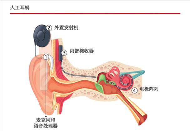  人工耳蜗