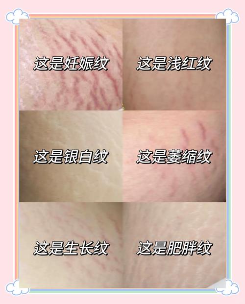 妊娠纹几率