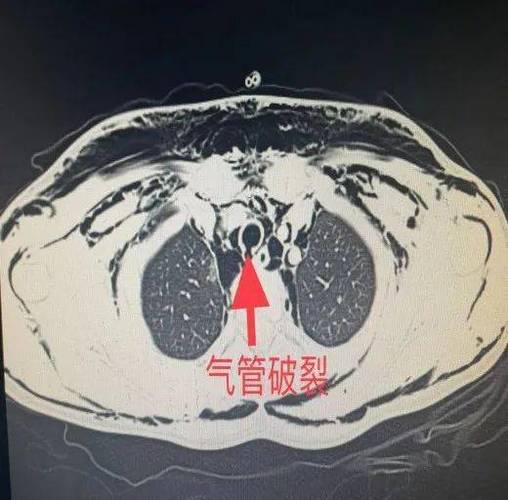 气管意外
