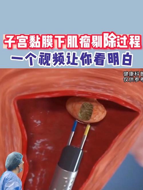 粘膜下肌瘤
