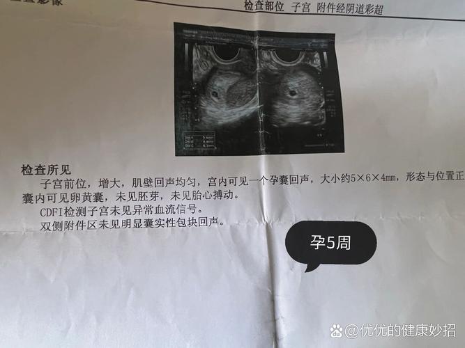 微弱胎心