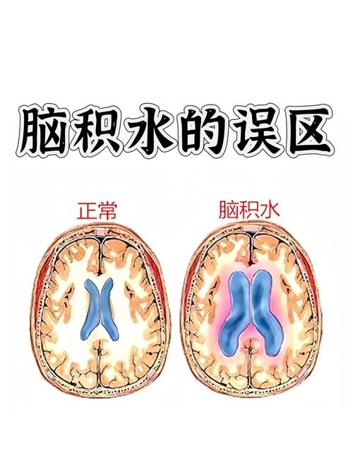 脑积水