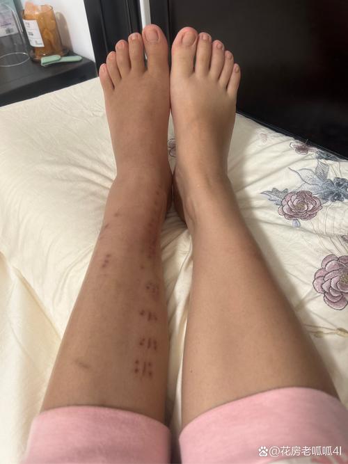 移植后腿疼