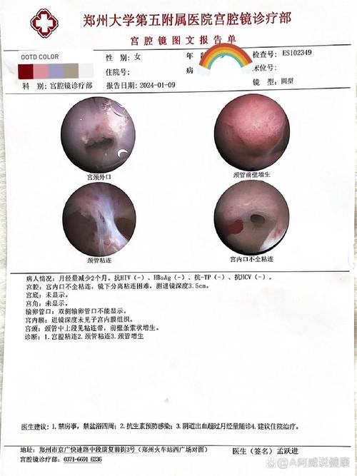 70天宫腔镜