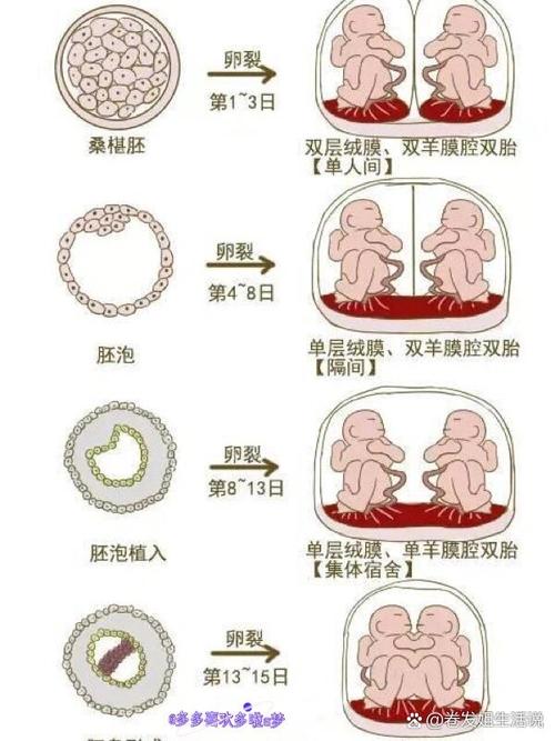 半同卵双胎