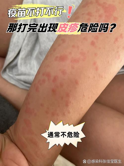 打针过敏
