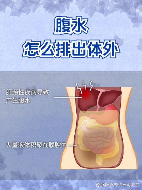 卵泡期腹水