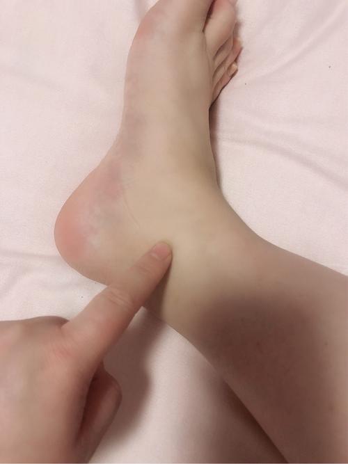 脚丫肿胀