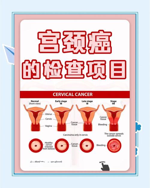 子宫内膜癌筛查
