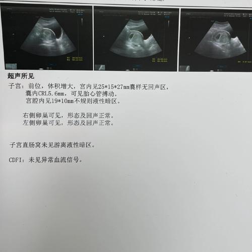 宫腔积液