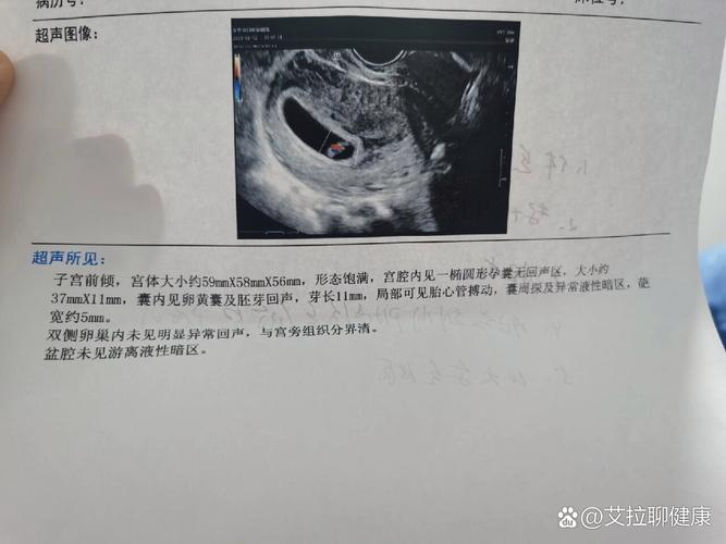 囊周积液