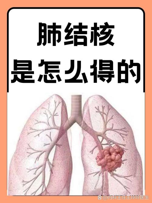  肺结核