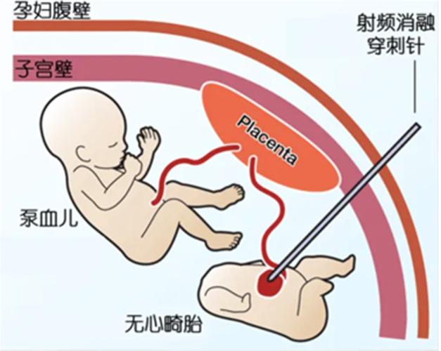 剪胎技术