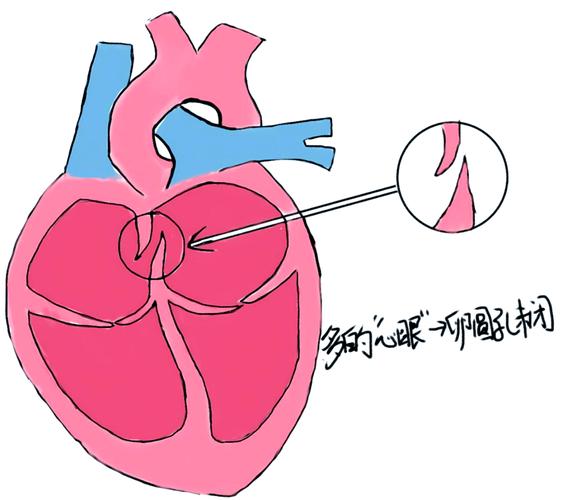 心脏小孔
