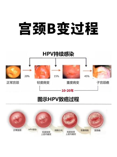 宫颈病变