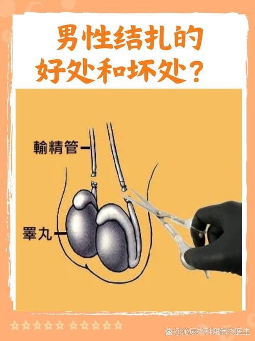  无需结扎