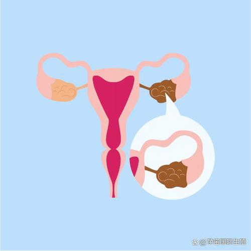 子宫囊肿，影响试管婴儿吗？