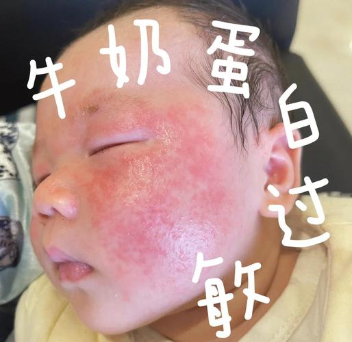 牛奶过敏
