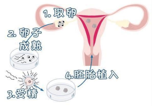 试管婴儿：卵巢为何会变大？
