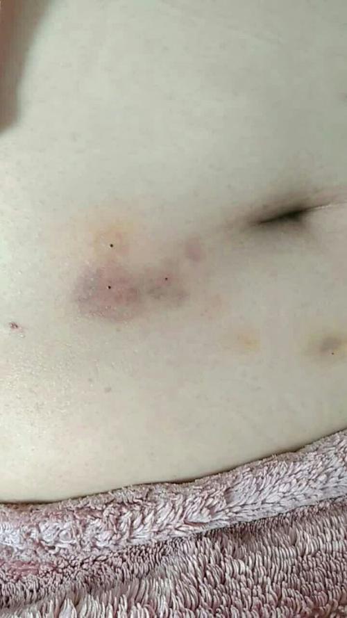 肚子针眼