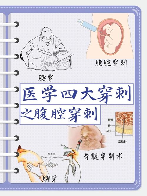 腹腔穿刺术