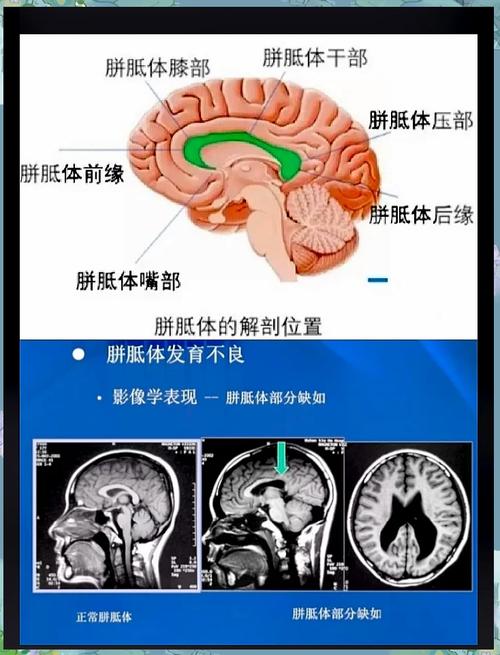  胼胝体发育