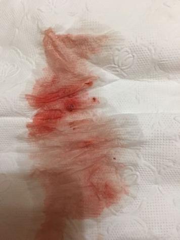 试管婴儿移植后没憋尿会怎么样？