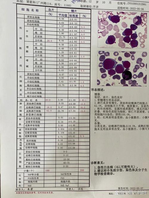 急性淋巴细胞白血病
