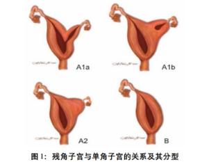单角子宫