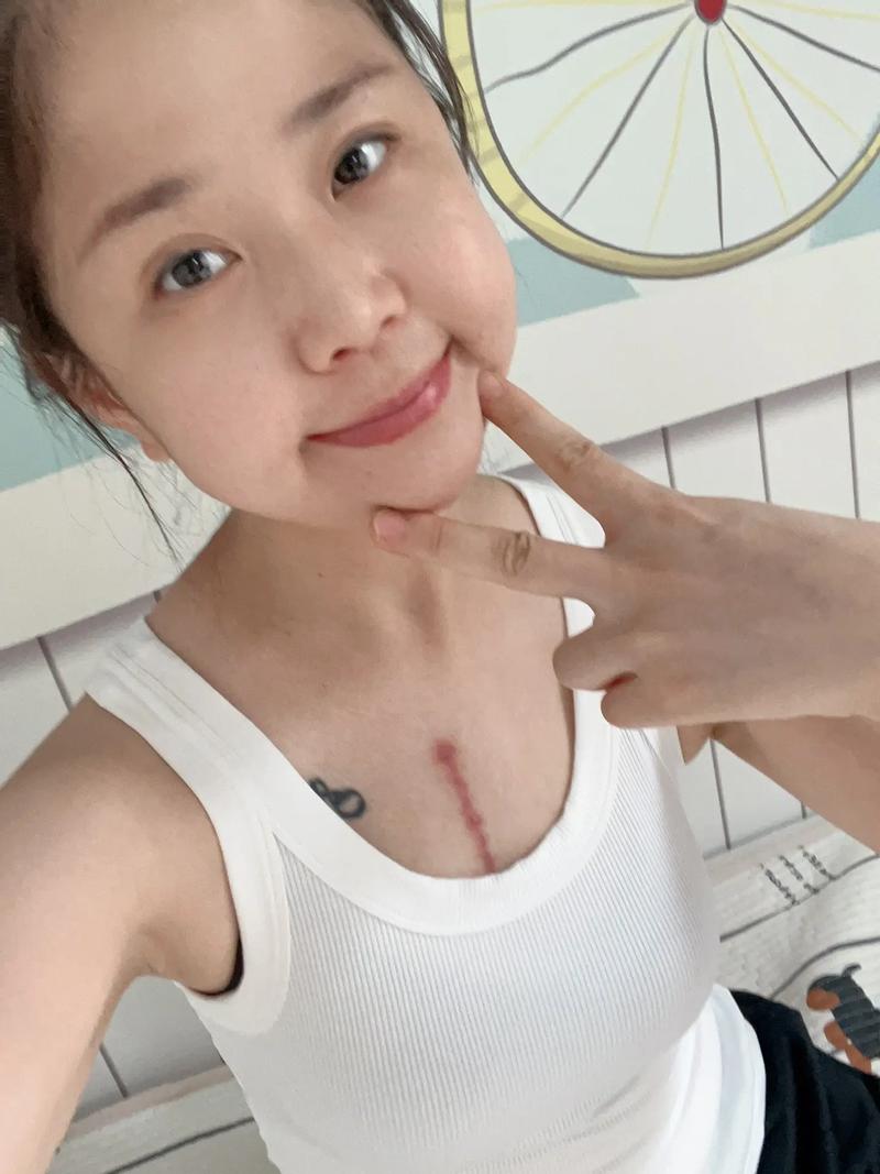  移植术后