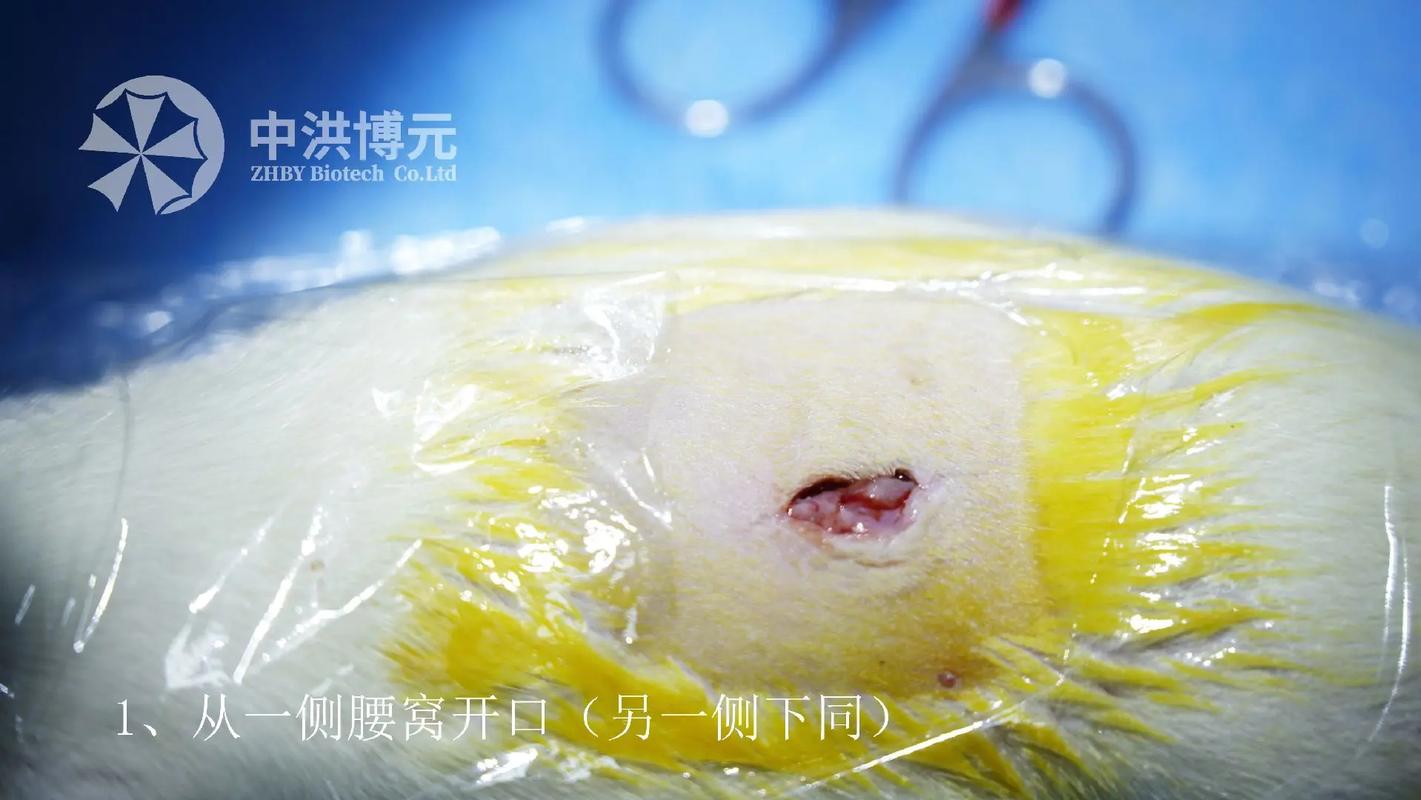 双侧卵巢切除